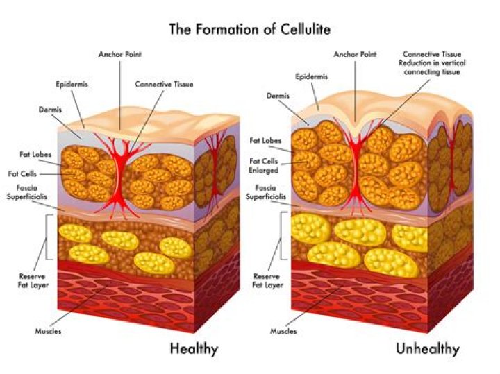 What causes cellulite on stomach?